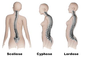 lordose cyphose et scoliose en chiropractie