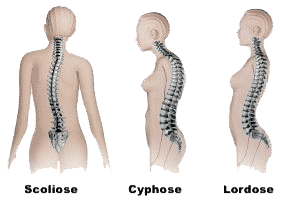 Scolioses, Cyphoses, Lordoses: les réponses du chiropracteur...