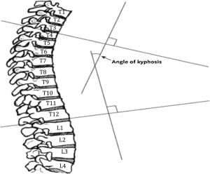 degrés de cyphose mesurés en chiropractie