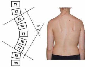 mesure angle scoliose en chiropraxie