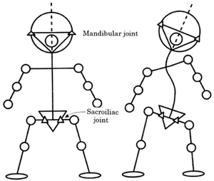 SOT torsion et posture latéralisée