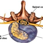 Les Hernies Discales.. Quelles VRAIES solutions?