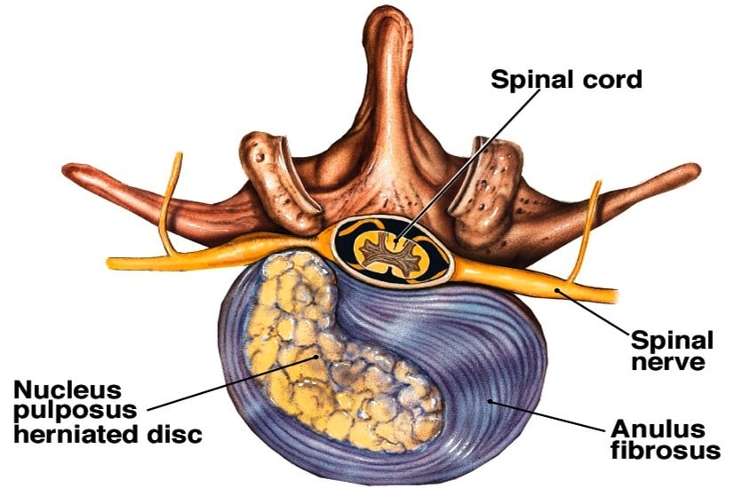 Qu'est-ce que le nerf sciatique?  Chiro Axion - Clinique chiropratique