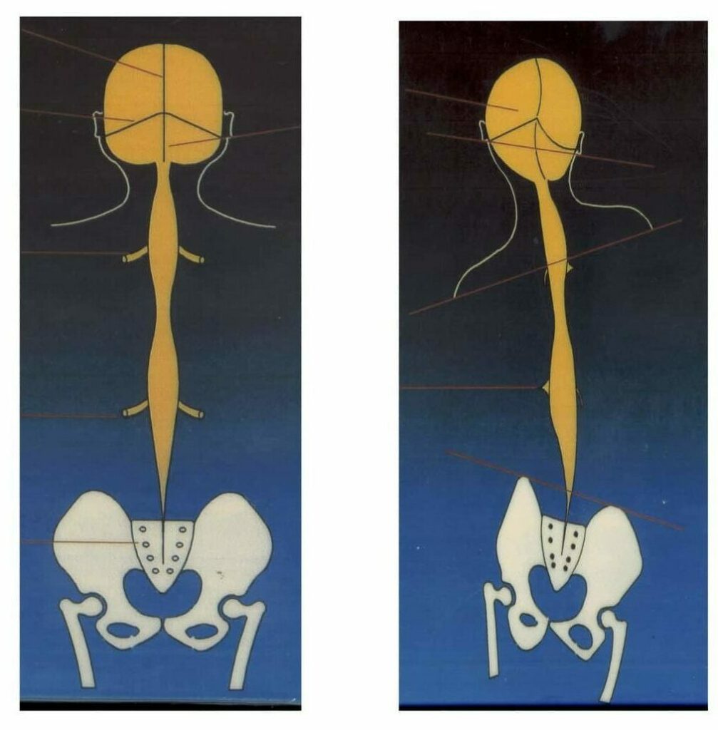 torsions des méninges et du bassin en chiropraxie