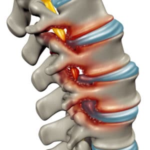 discarthrose acidité systémique et chiropractie