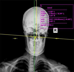 Radios Atlas Specific- Chiropractic