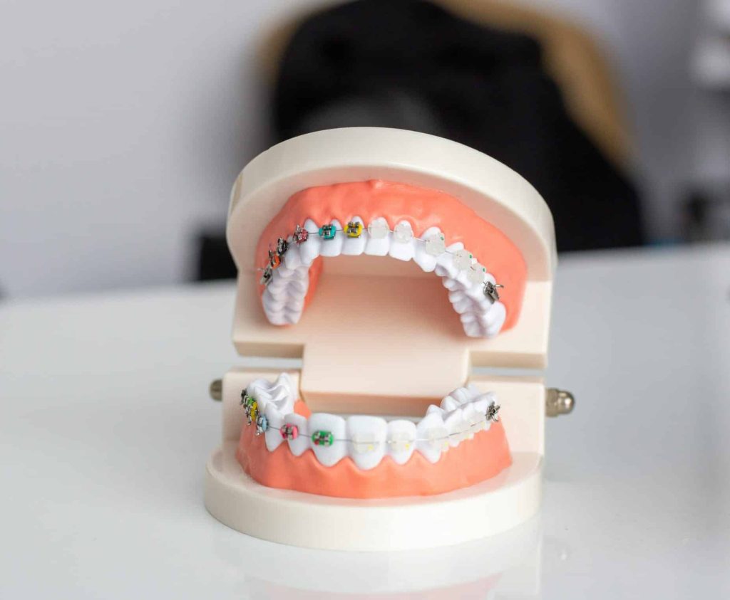 dentaire orthodontie et chiropraxie - bagues dentaires