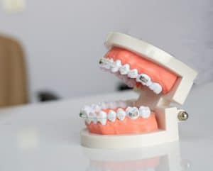 soins dentaires, orthodontie et chiropraxie - bagues dentaires