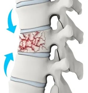 fissures & fractures par compression